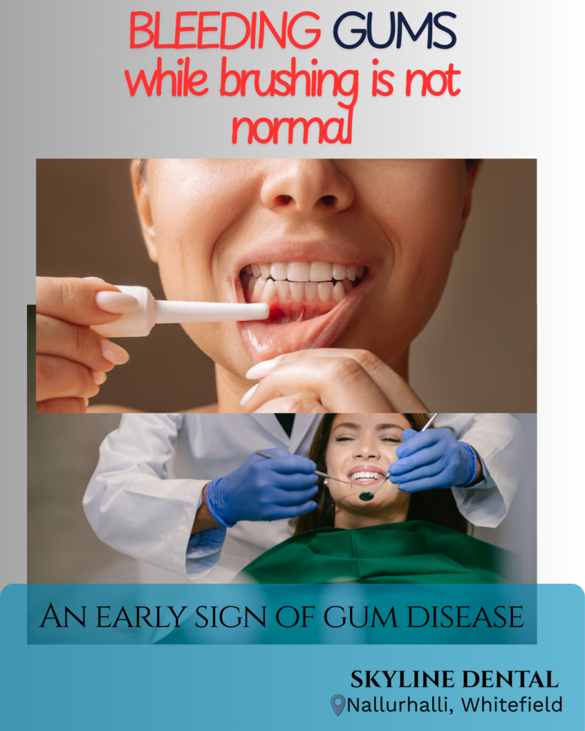 Bleeding gums while brushing – signs of gum disease explained by dentist in Whitefield