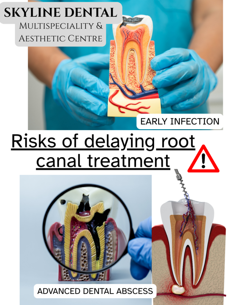 Risks of delaying root canal treatment explained by dentist in Whitefield