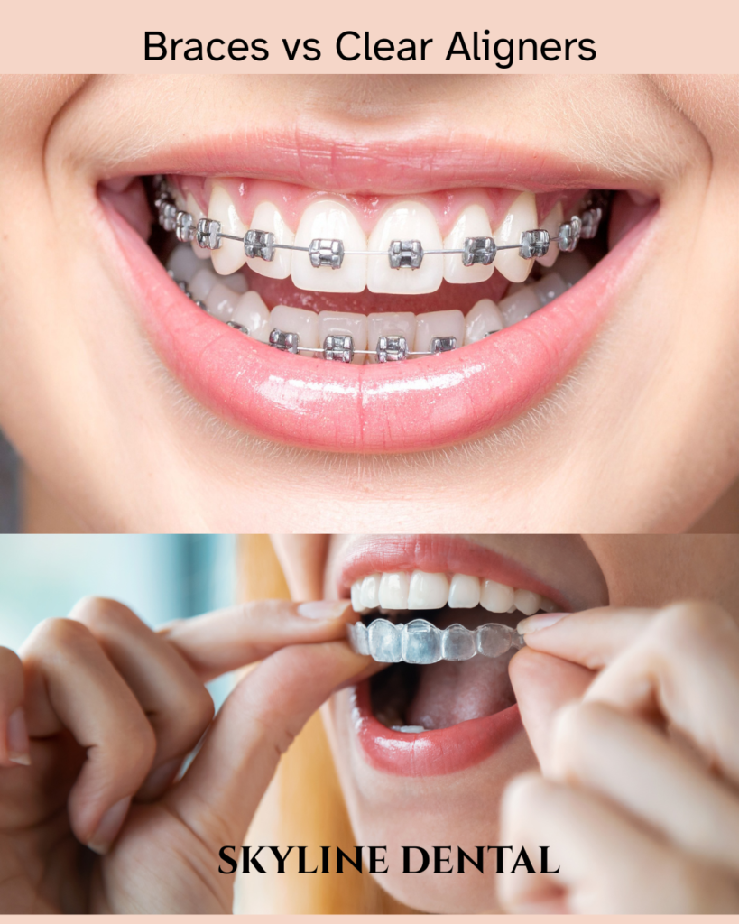 Comparison of braces and clear aligners in Whitefield dental clinic