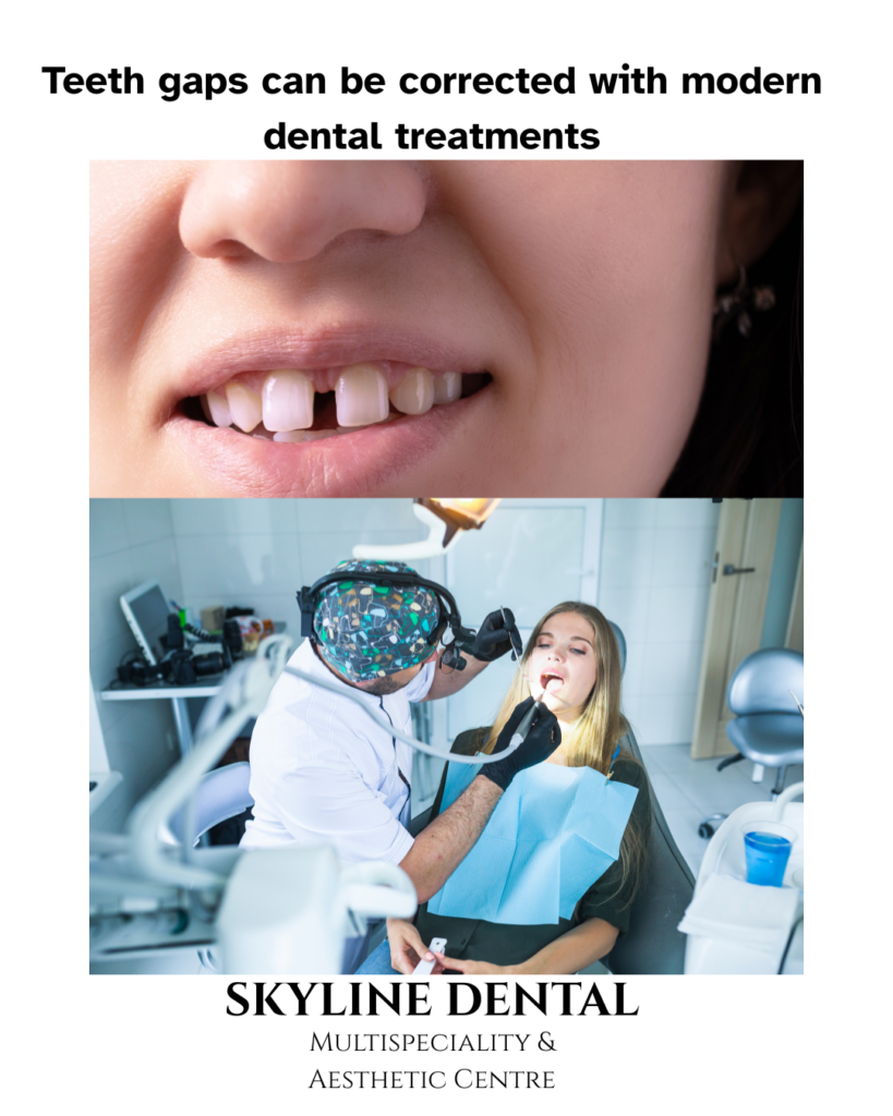 Gap between teeth treatment by dentist in Whitefield