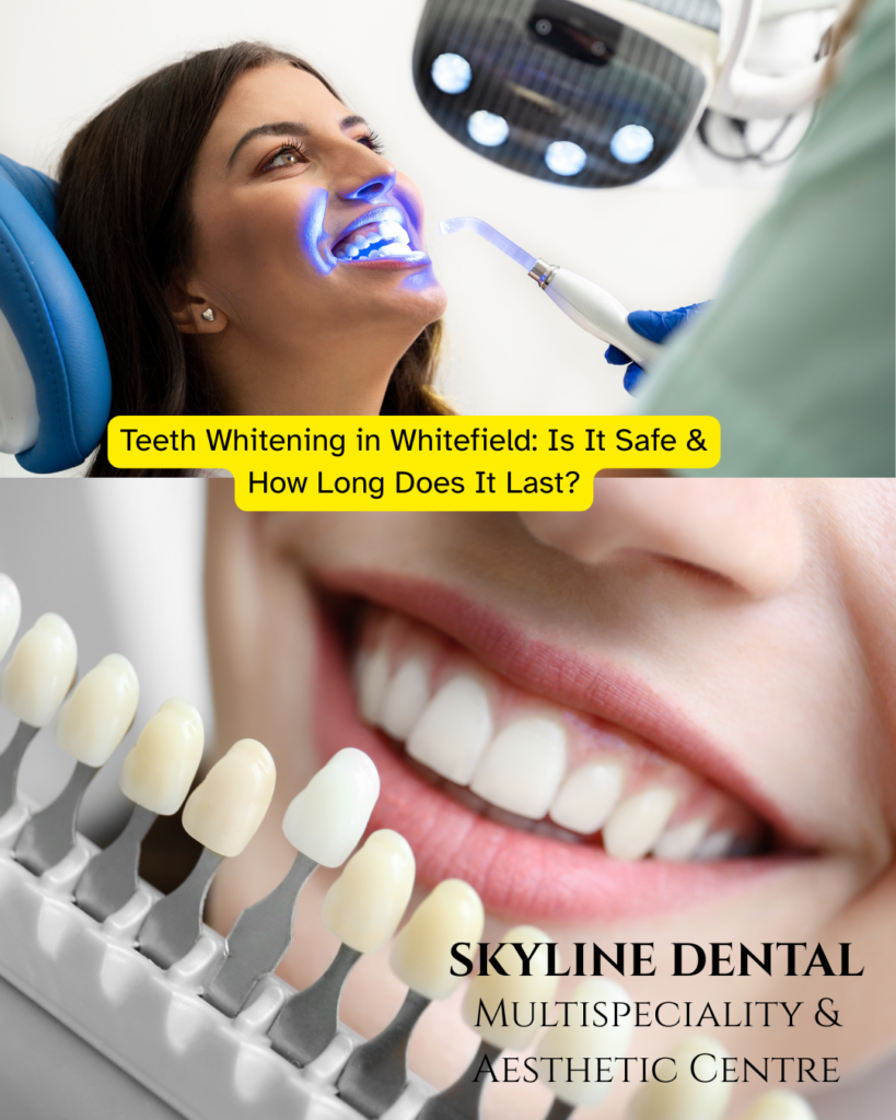 Teeth whitening treatment in Whitefield dental clinic