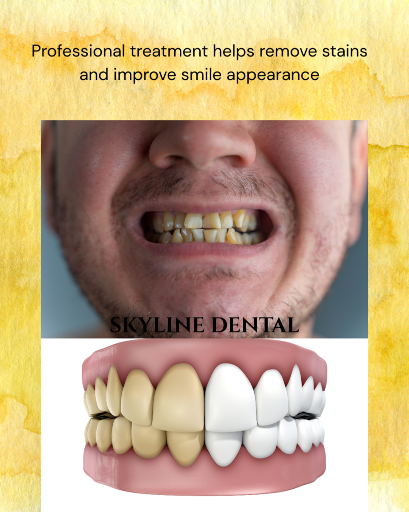 Yellow teeth whitening treatment in Whitefield