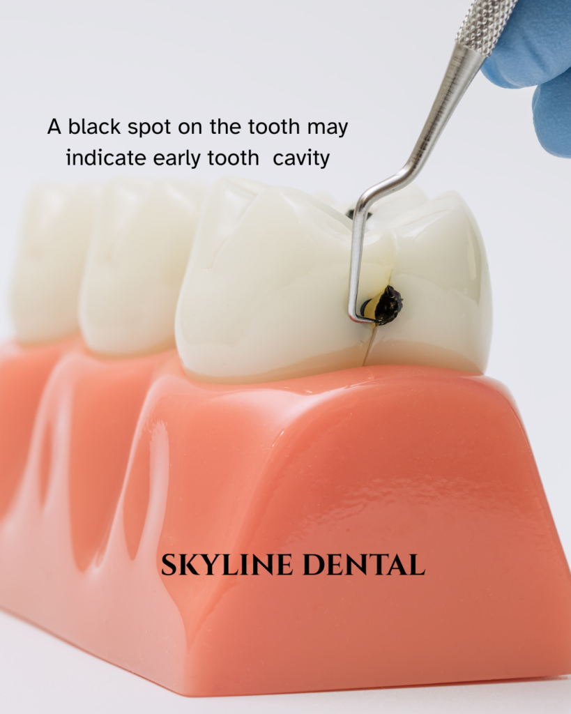 Black spot on tooth treated by dentist in Whitefield