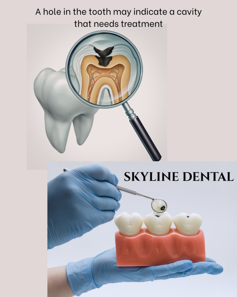 Hole in tooth treatment and dental filling in Whitefield