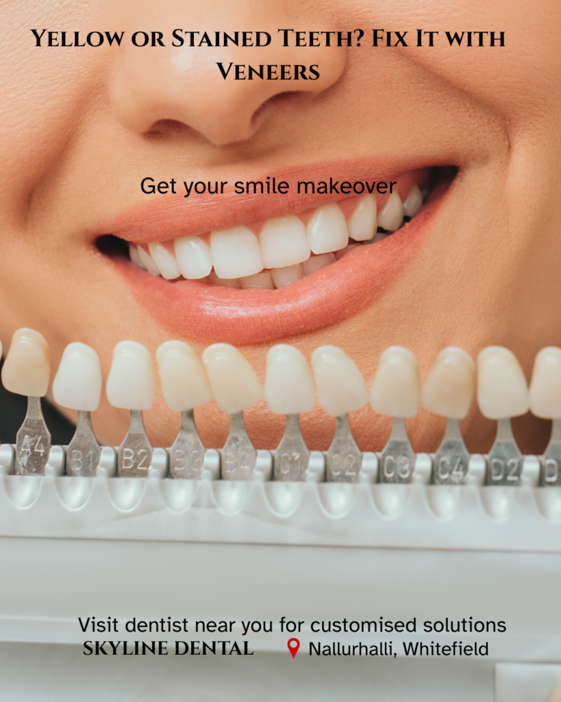 veneers for yellow teeth whitefield